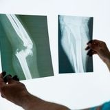 RTG kończyn dolnych na stojąco