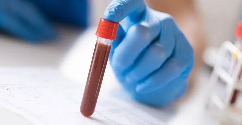 Podwyższona kreatynina - co oznacza, jakie są normy kreatyniny