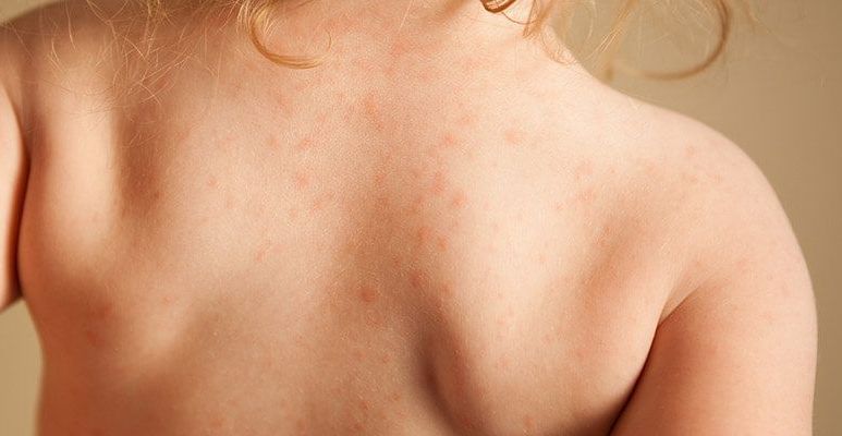 Szkarlatyna (płonica) - jakie są objawy, przyczyny i leczenie