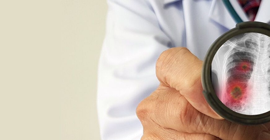 Zapalenie płuc u dziecka i niemowlaka możę pojawić się w wyniku różnych infekcji. Zapalenie płuc leczone jest w zależności od pojawiających się objawów.