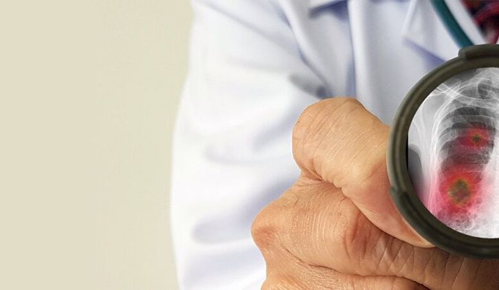 Zapalenie płuc u dziecka i niemowlaka możę pojawić się w wyniku różnych infekcji. Zapalenie płuc leczone jest w zależności od pojawiających się objawów.