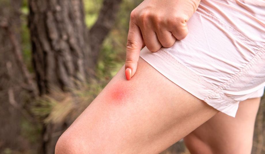 Ugryzienie kleszcza - co robić?