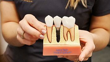 Konsultacja implantologiczna