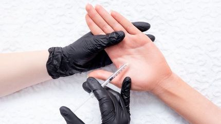 Toksyna Botulinowa botox/vistabel - leczenie nadpotliwości dłoni